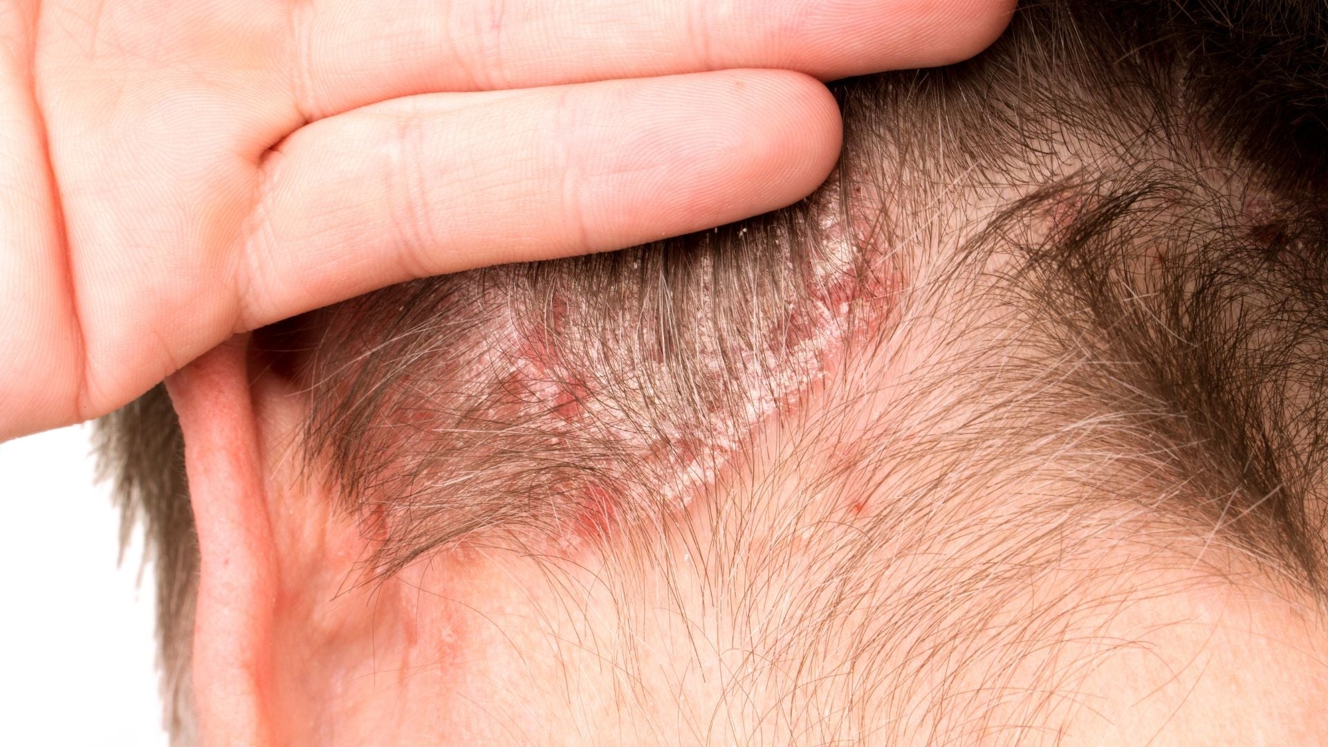 How Autoimmune Activity Manifests on the Scalp