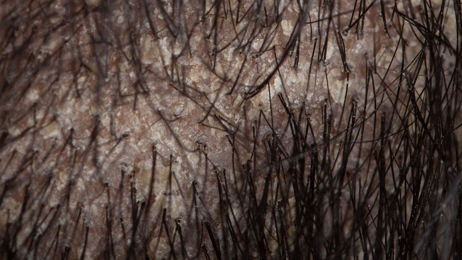 How do I Tell if my Itchy Scalp is Contact Dermatitis or Dandruff?