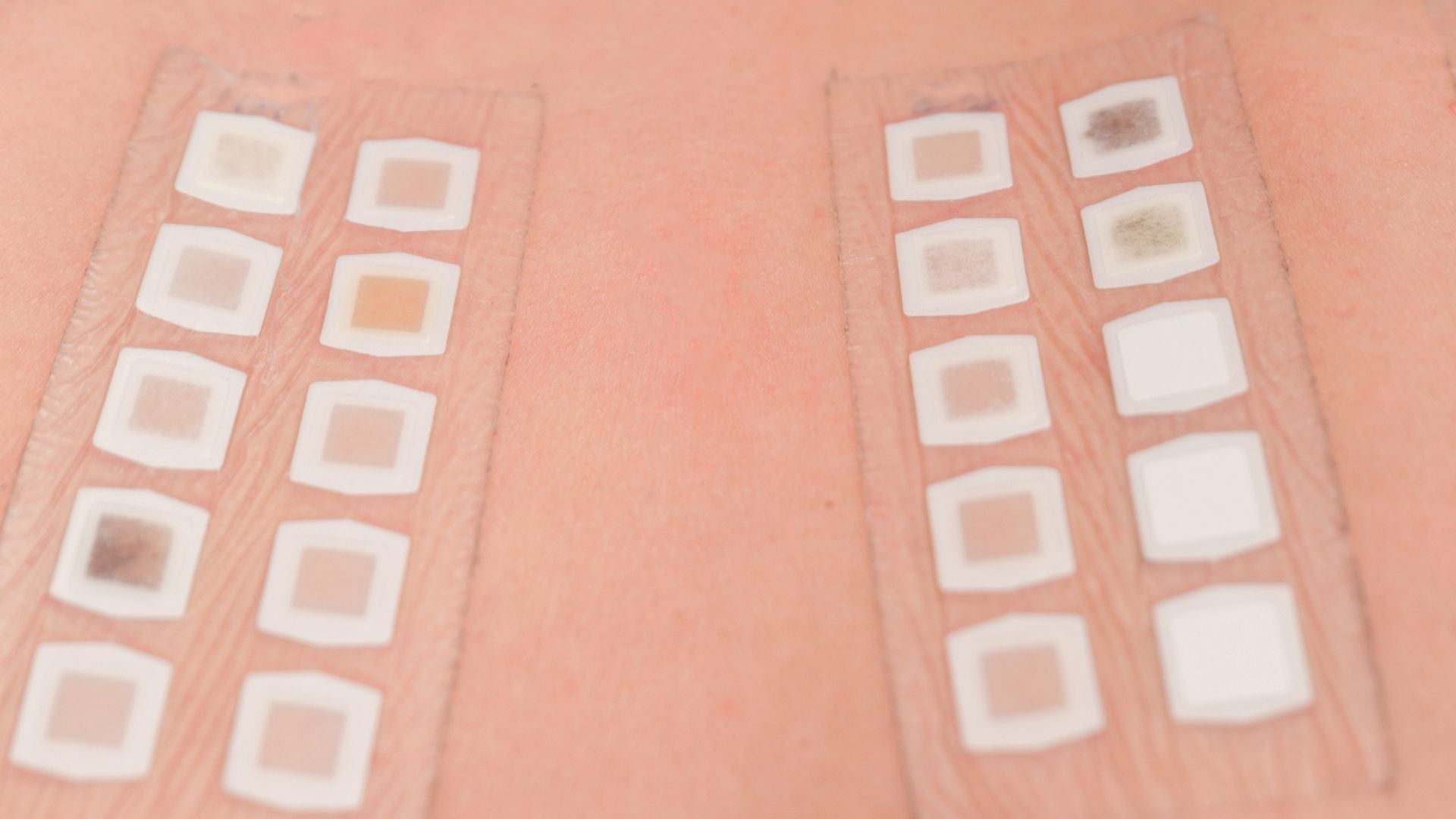 Patch Testing for Sensitive Scalp: Benchmarks for Guided Remission
