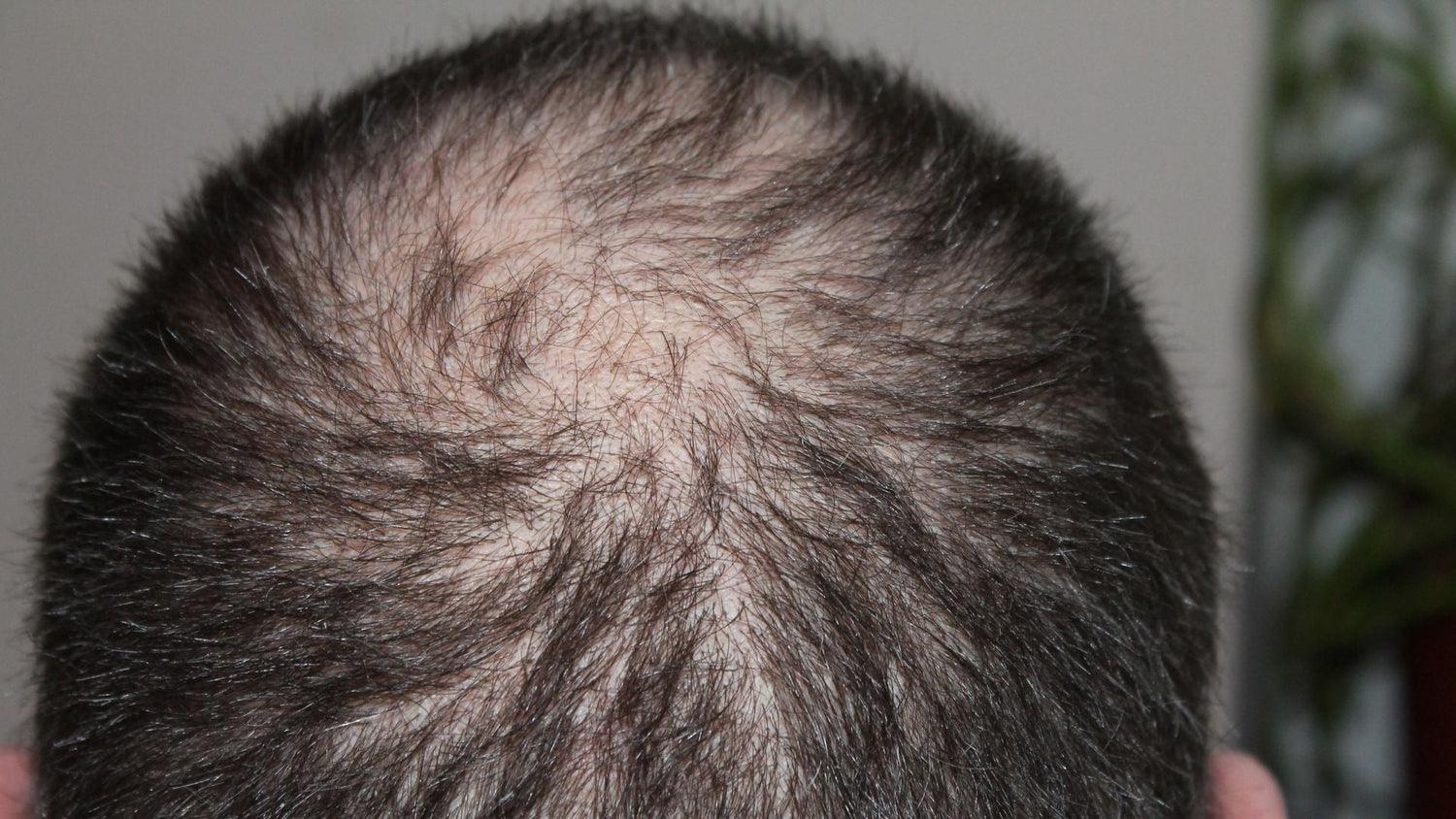 Hormonal Imbalance Testing for Patterned Hair Loss: A Complete Evaluation Guide