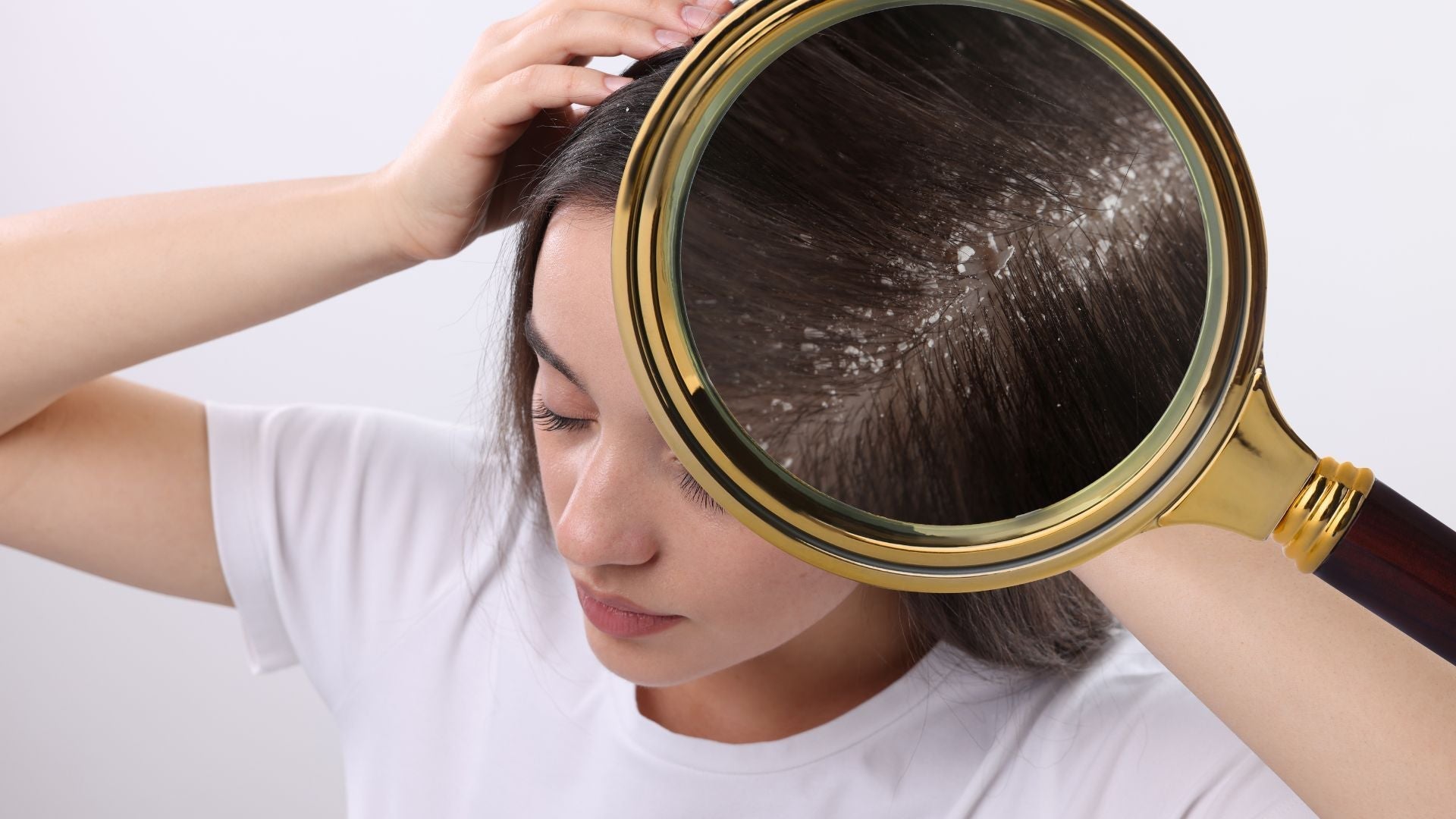 Seborrheic Dermatitis vs Dandruff: Key Differences, Causes, and Care