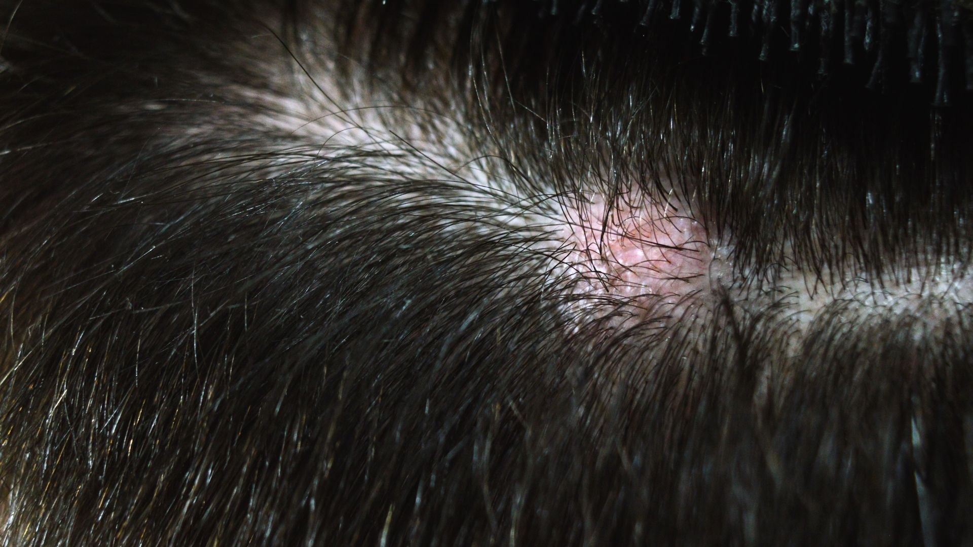 How Inflammatory Scalp Pathways Work