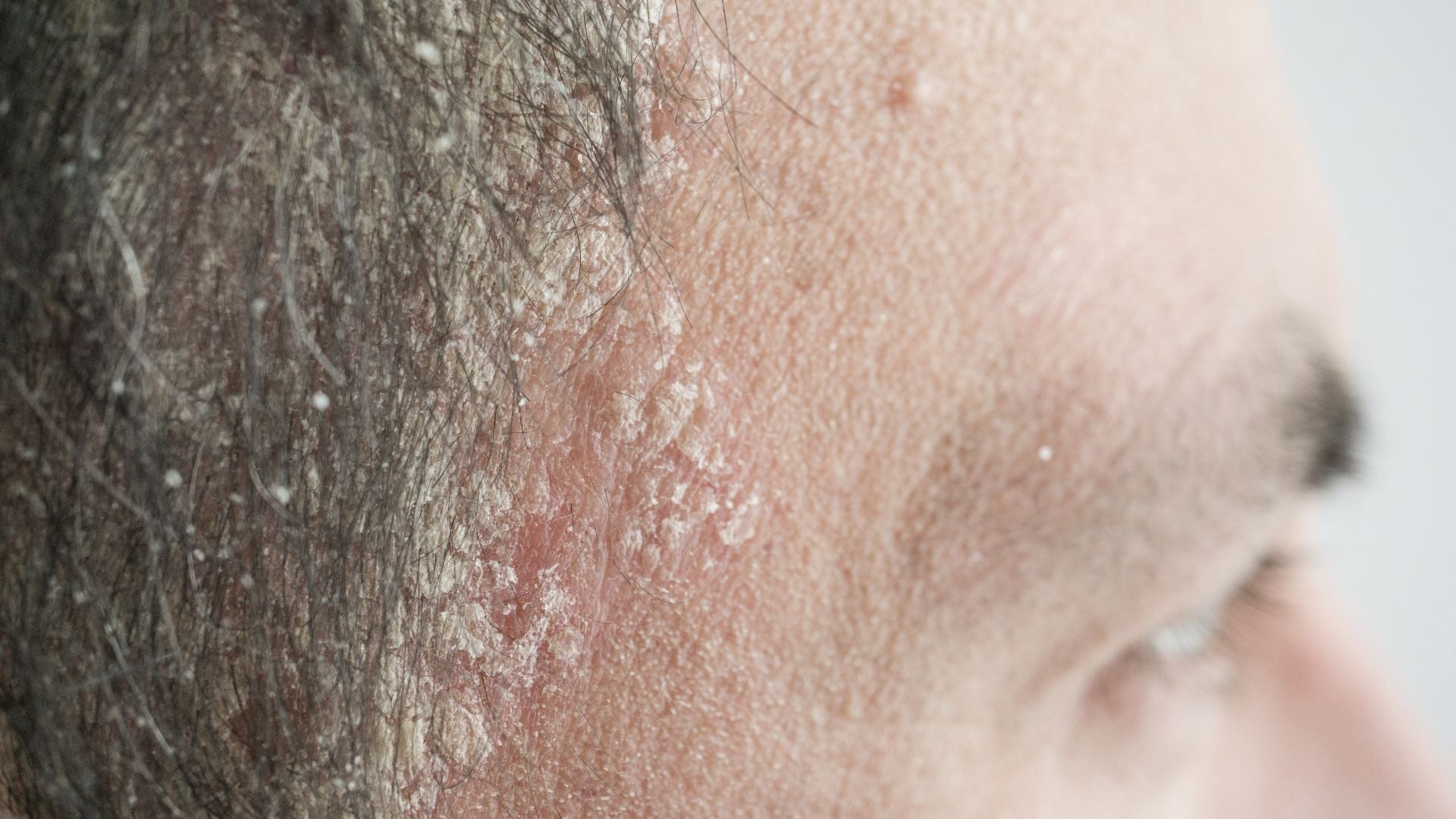 Scalp Psoriasis: How Cell Overgrowth Triggers Plaques and Itching