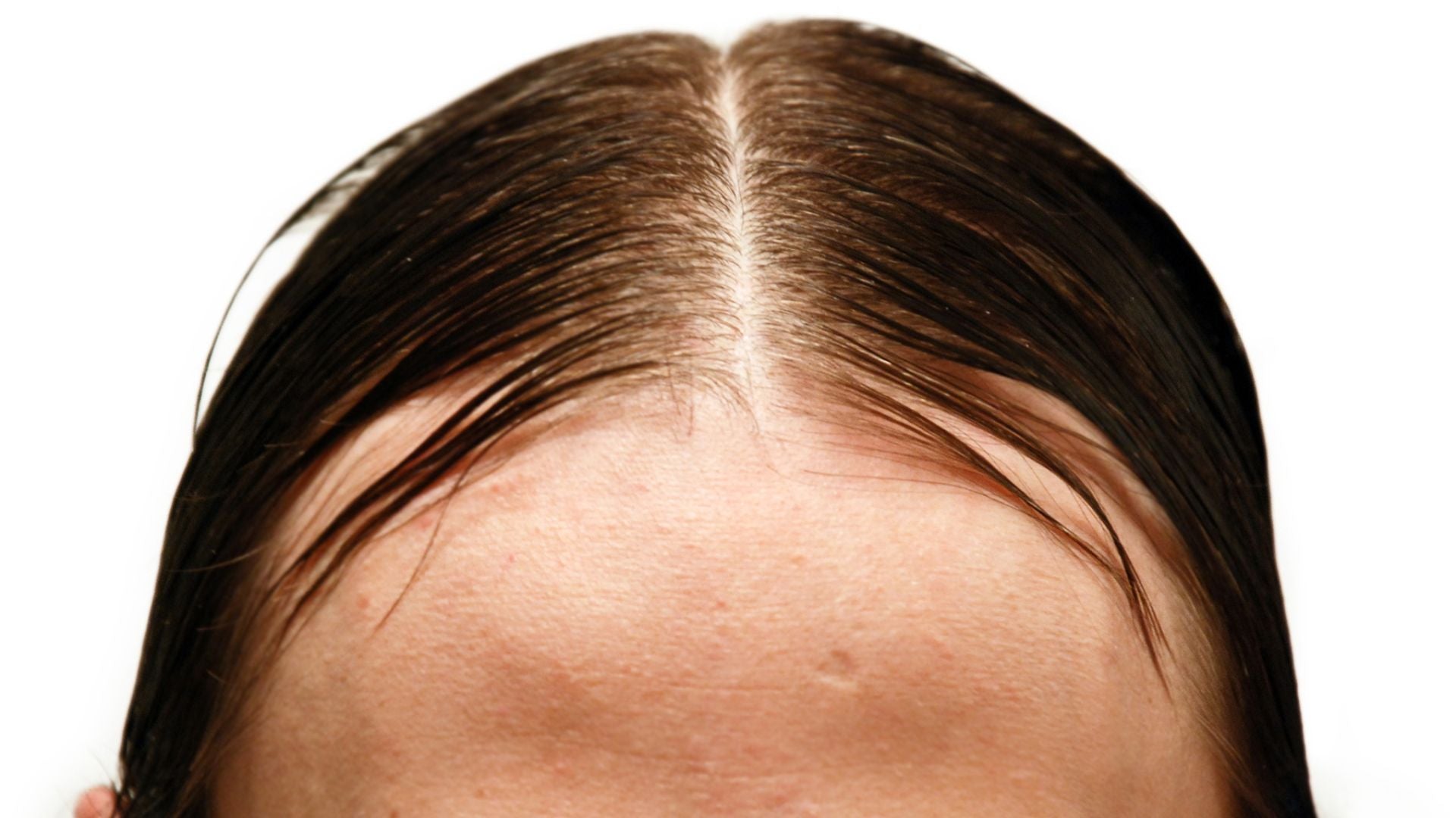 Sebum Balance Strategies: Restoring Scalp Barrier Health in Oily Hair