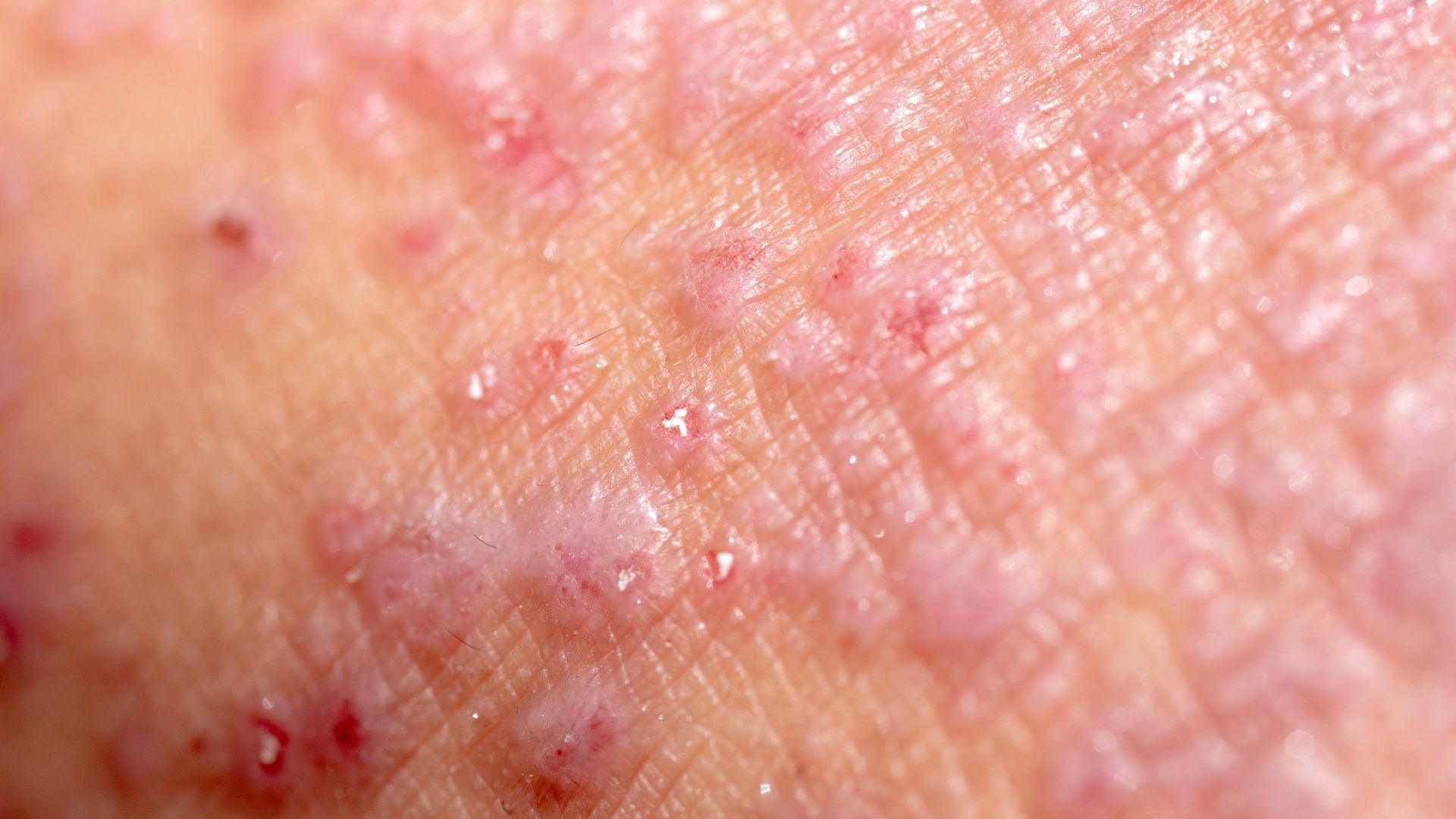 Scalp Contact Dermatitis: How Irritants and Allergens Trigger Inflammation