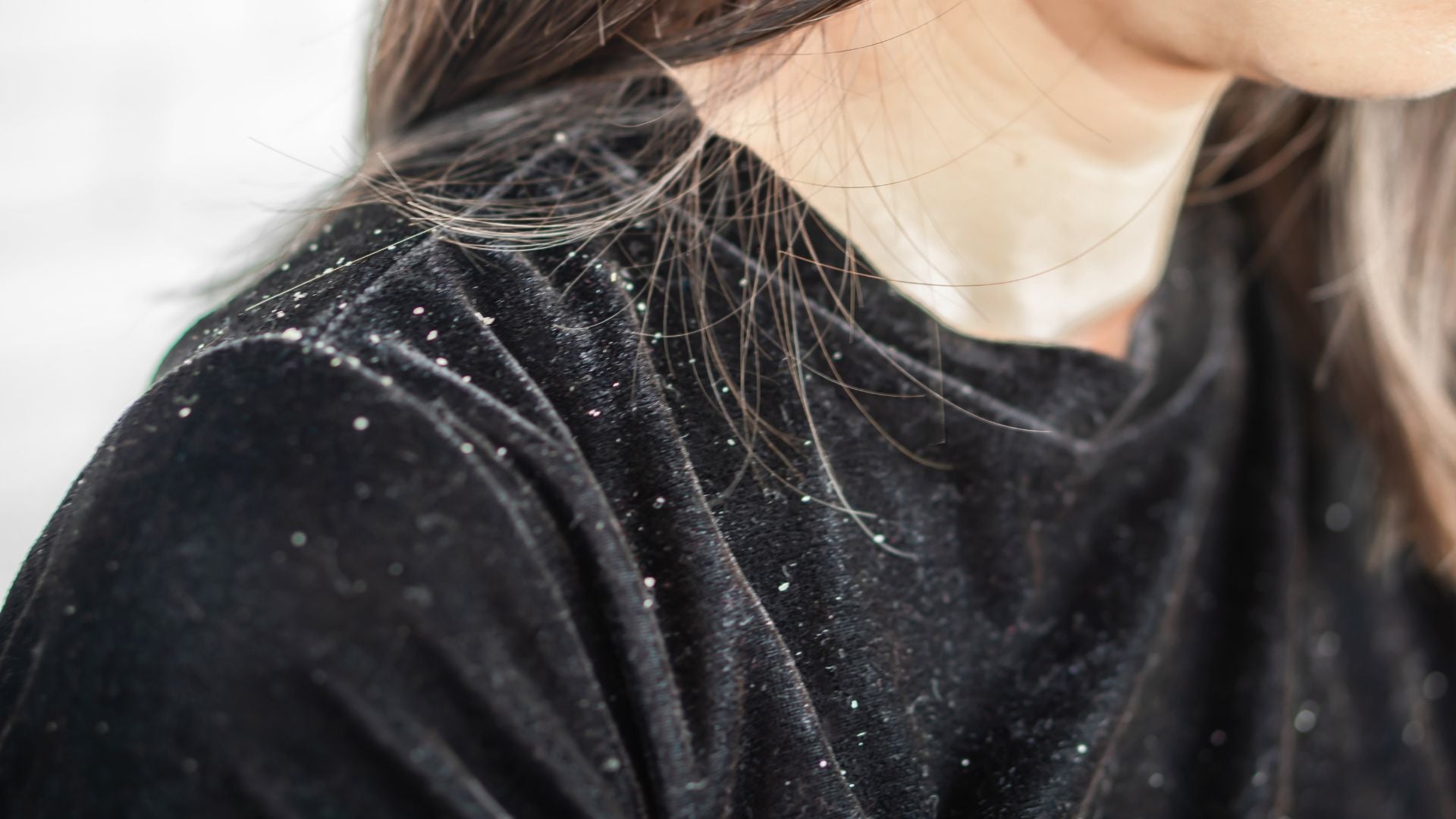 Why Do I Have Dandruff All of a Sudden and How to Get Rid of Them