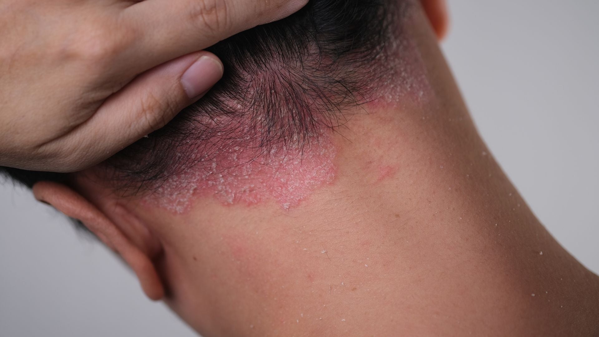 Seborrheic Dermatitis vs Psoriasis on the Scalp: Key Differences and Treatments