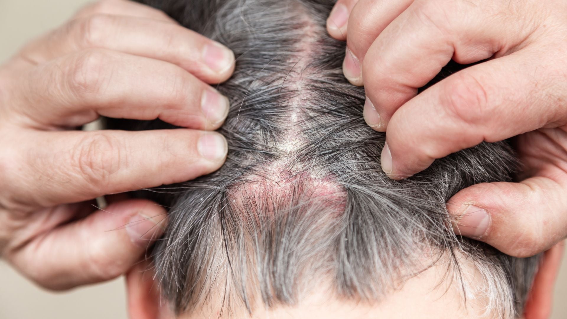 What is the Cause of a Sensitive Scalp & How to Treat It Naturally