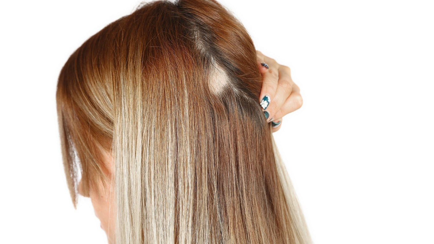 Intralesional Corticosteroid Protocol for Alopecia Areata