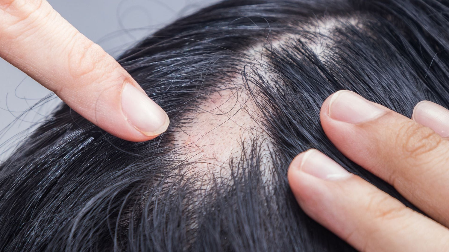 How Cicatricial Alopecia Progresses