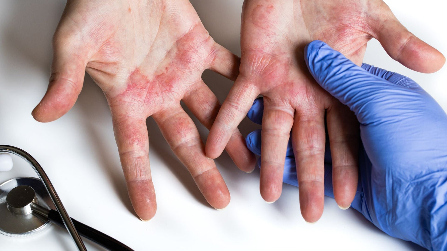 Contact Dermatitis Guide: Symptoms, Triggers, and When to Stop a Product