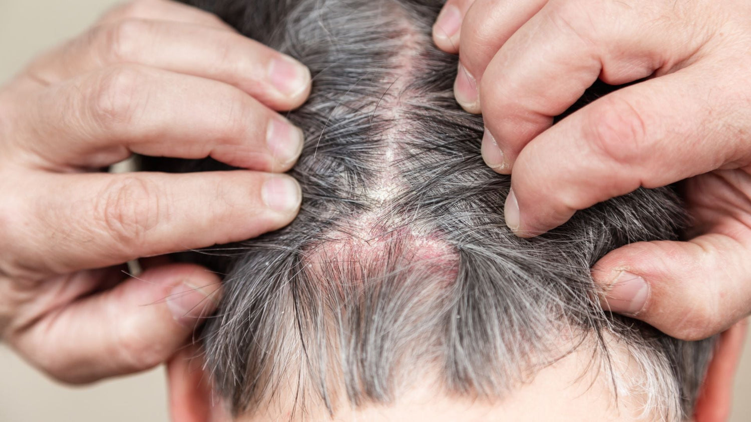Scalp Contact Dermatitis Recovery Workflow: Identify Triggers, Calm Inflammation, Prevent Relapse