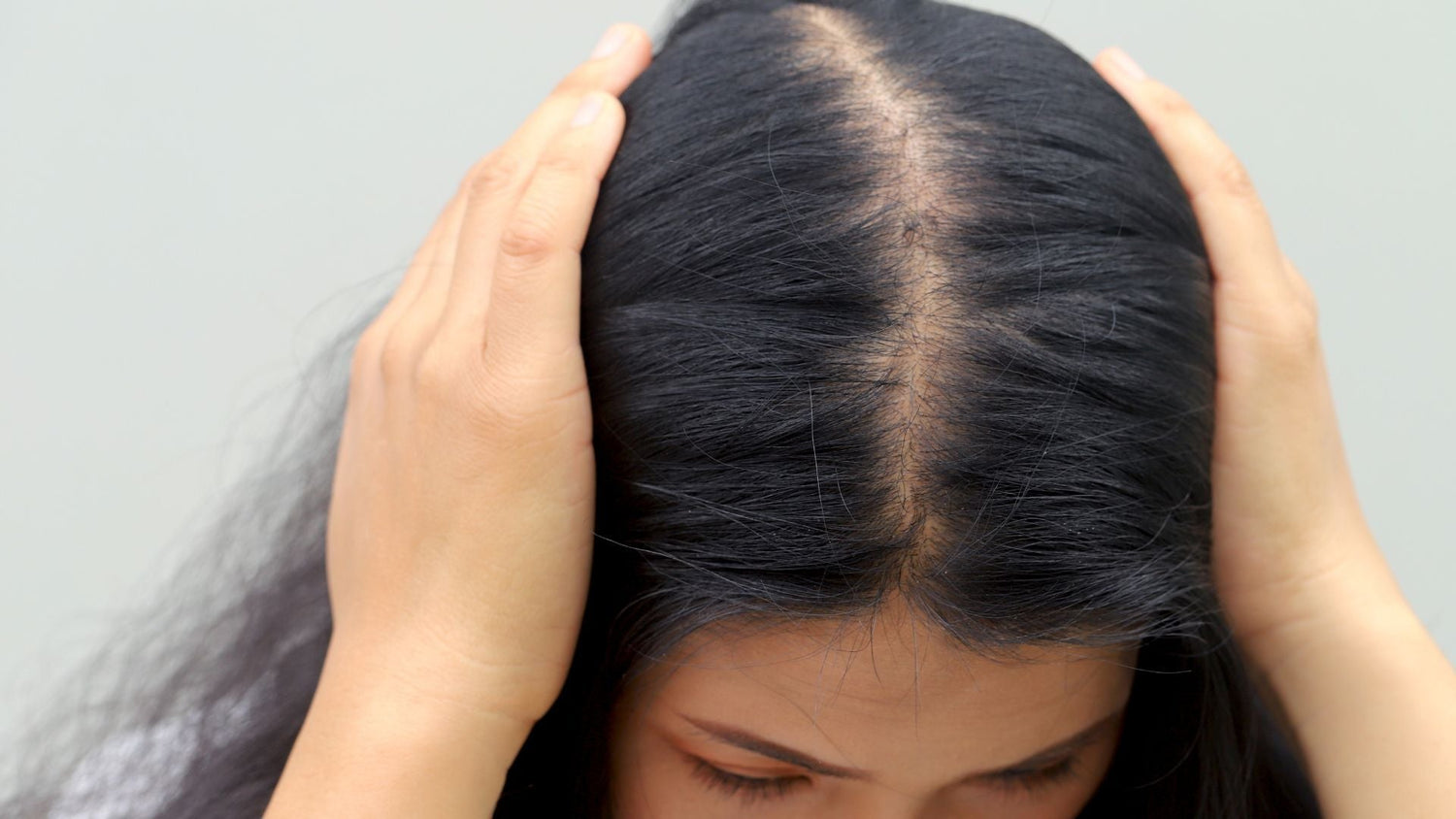 DHT and Hair Loss: Understanding Hormonal Triggers in Sensitive Scalps