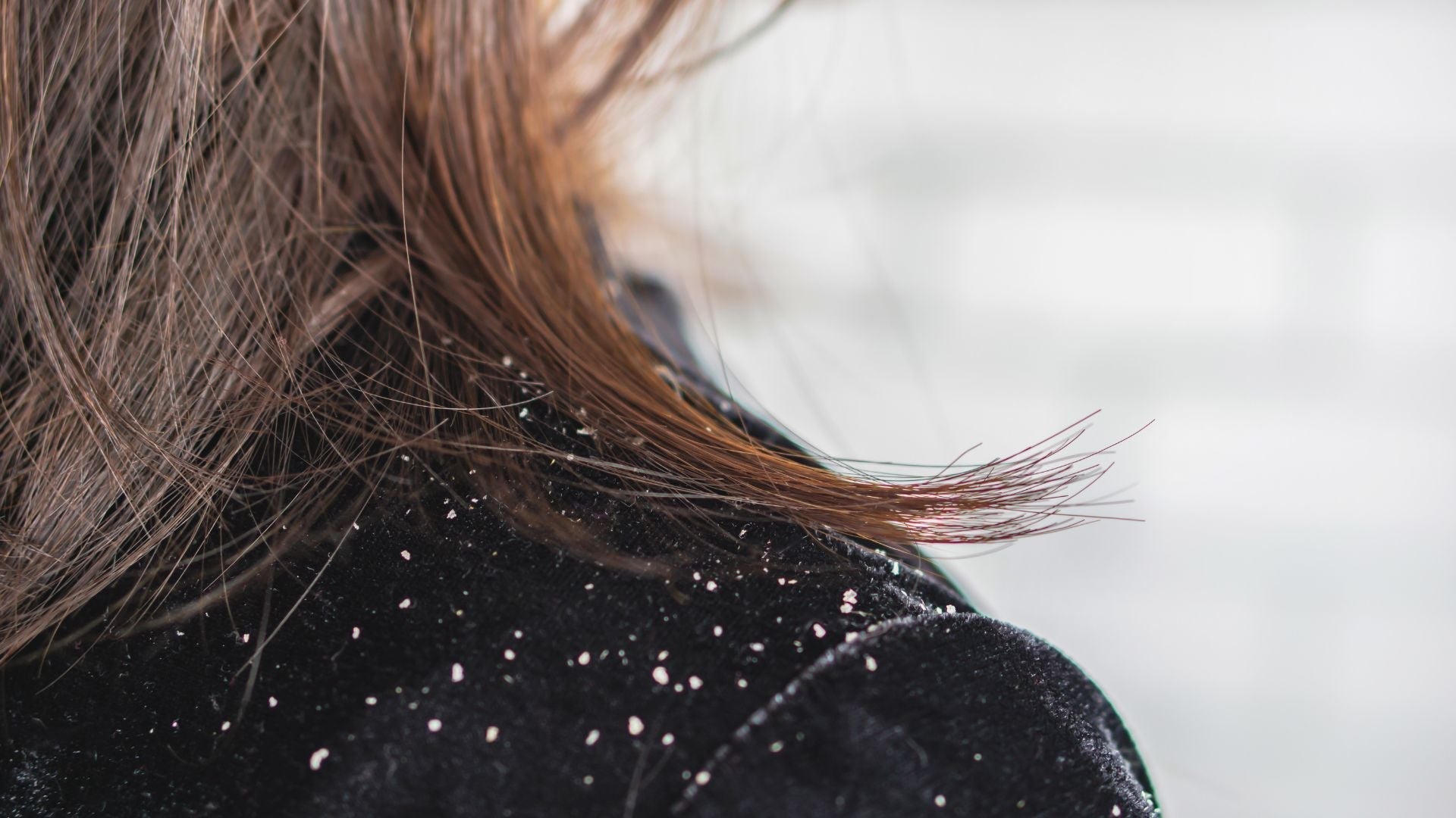 Dandruff vs Scalp Psoriasis: How to Identify and Treat Each Condition