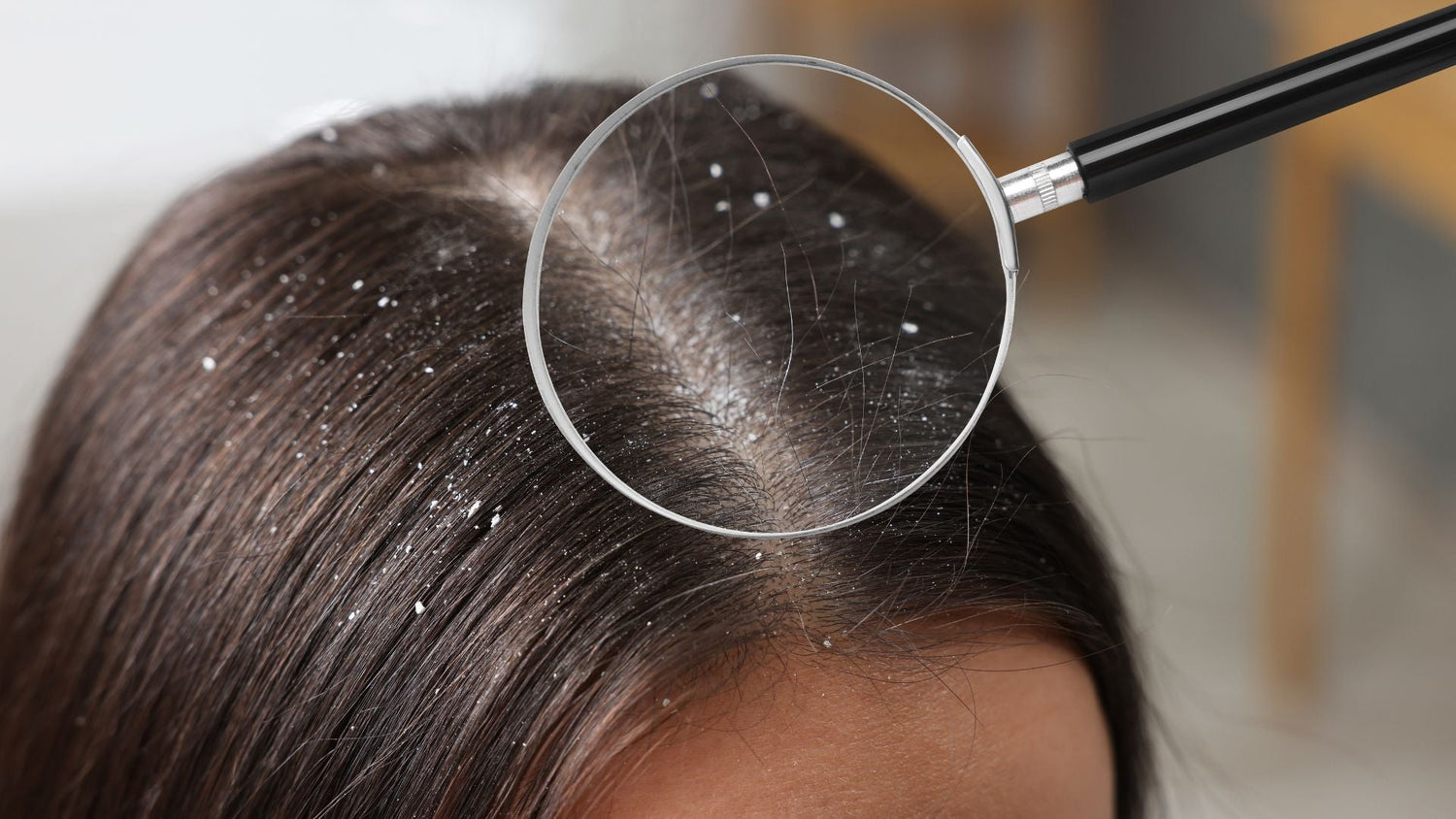 8 Week Dandruff Reset: Structured Scalp Care for Flake Reduction