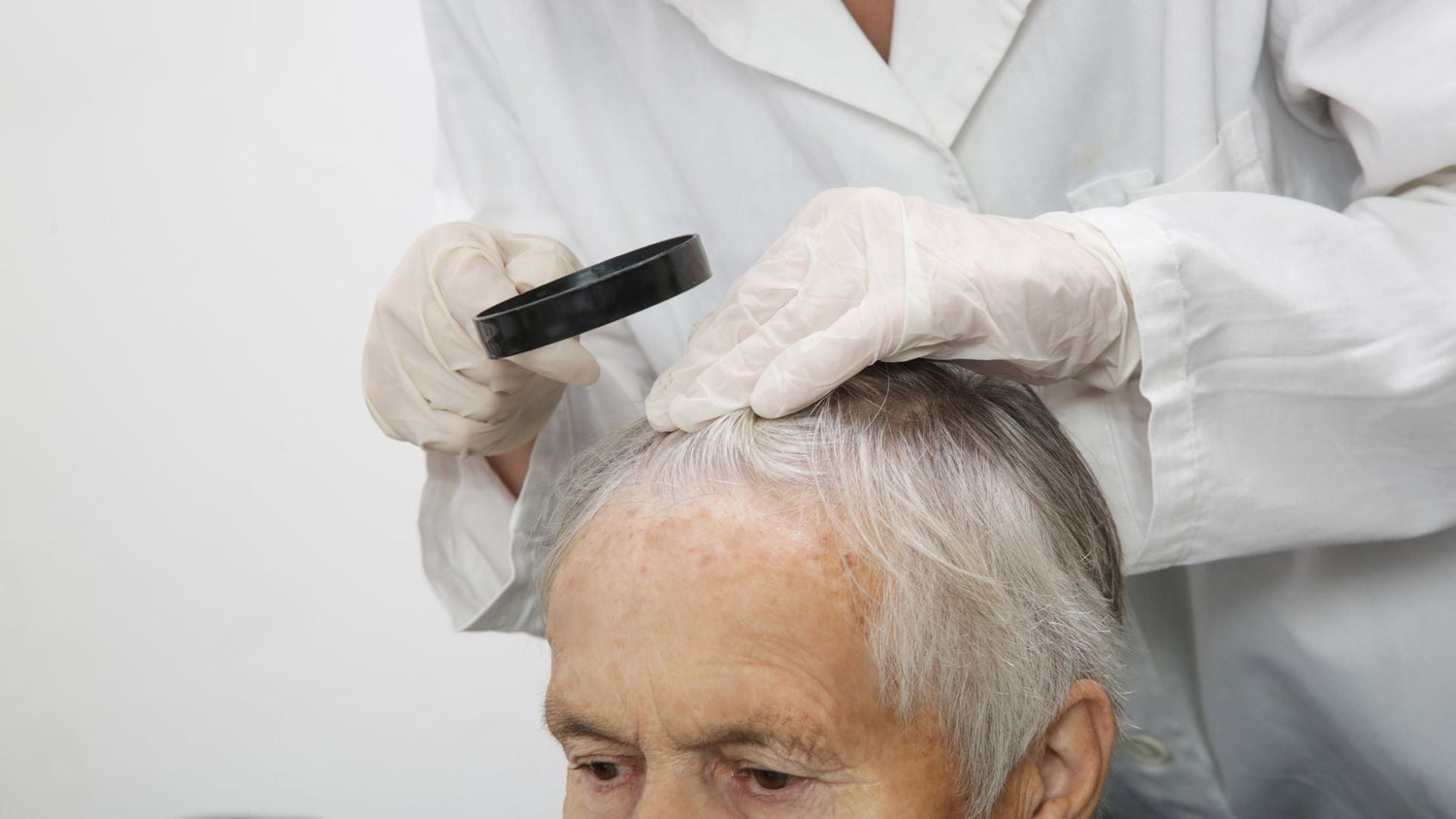 Scalp Eczema and Seborrheic Dermatitis Guide