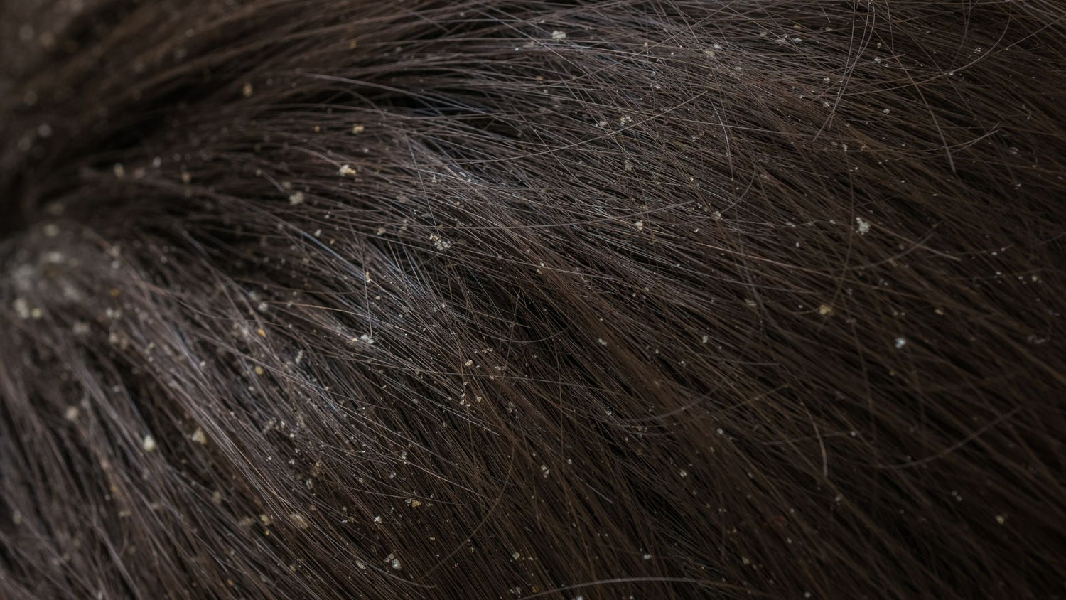 Scalp Flakes, Dryness, or Buildup: How to Tell the Difference