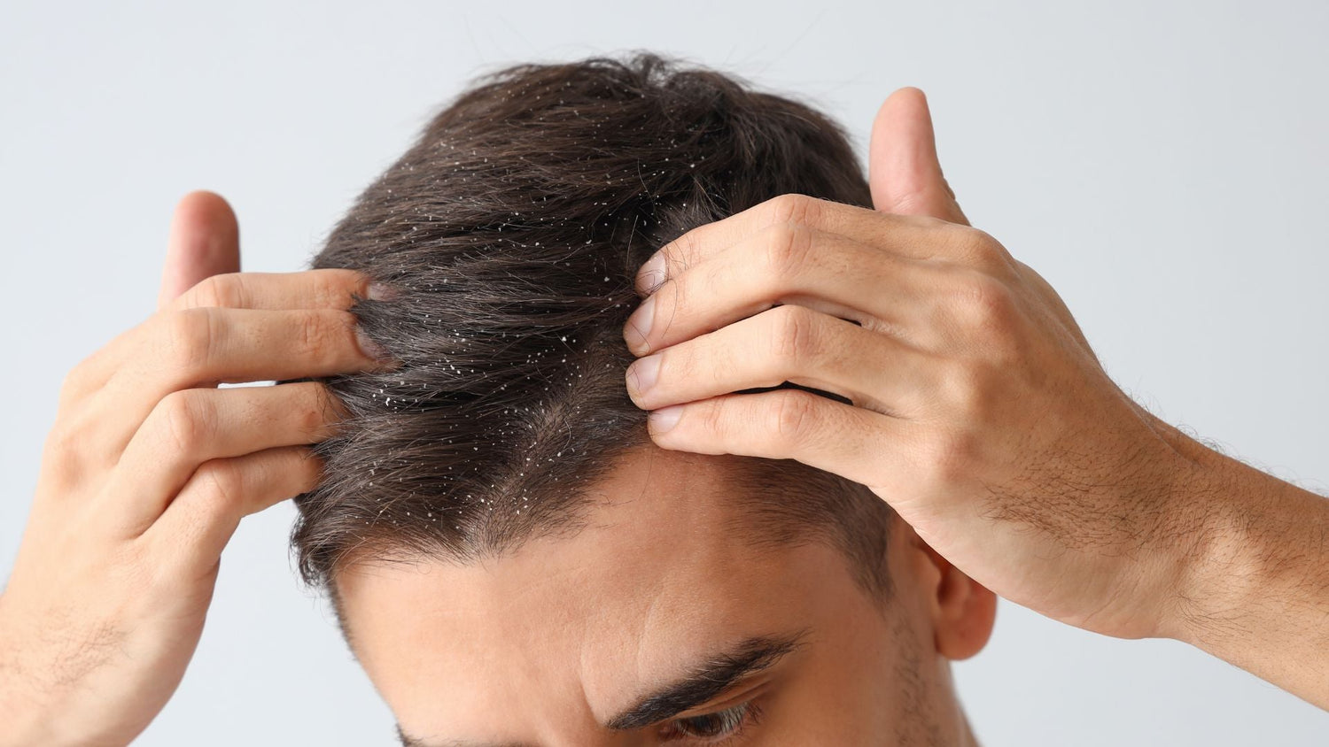 Seborrheic Dermatitis Control Benchmarks: Timelines, Endpoints, and Long-Term Relief