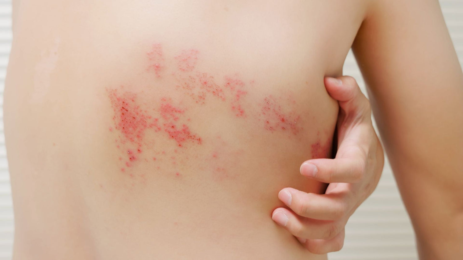 Flare-up Guide: Understanding Triggers, Timing, and Recovery