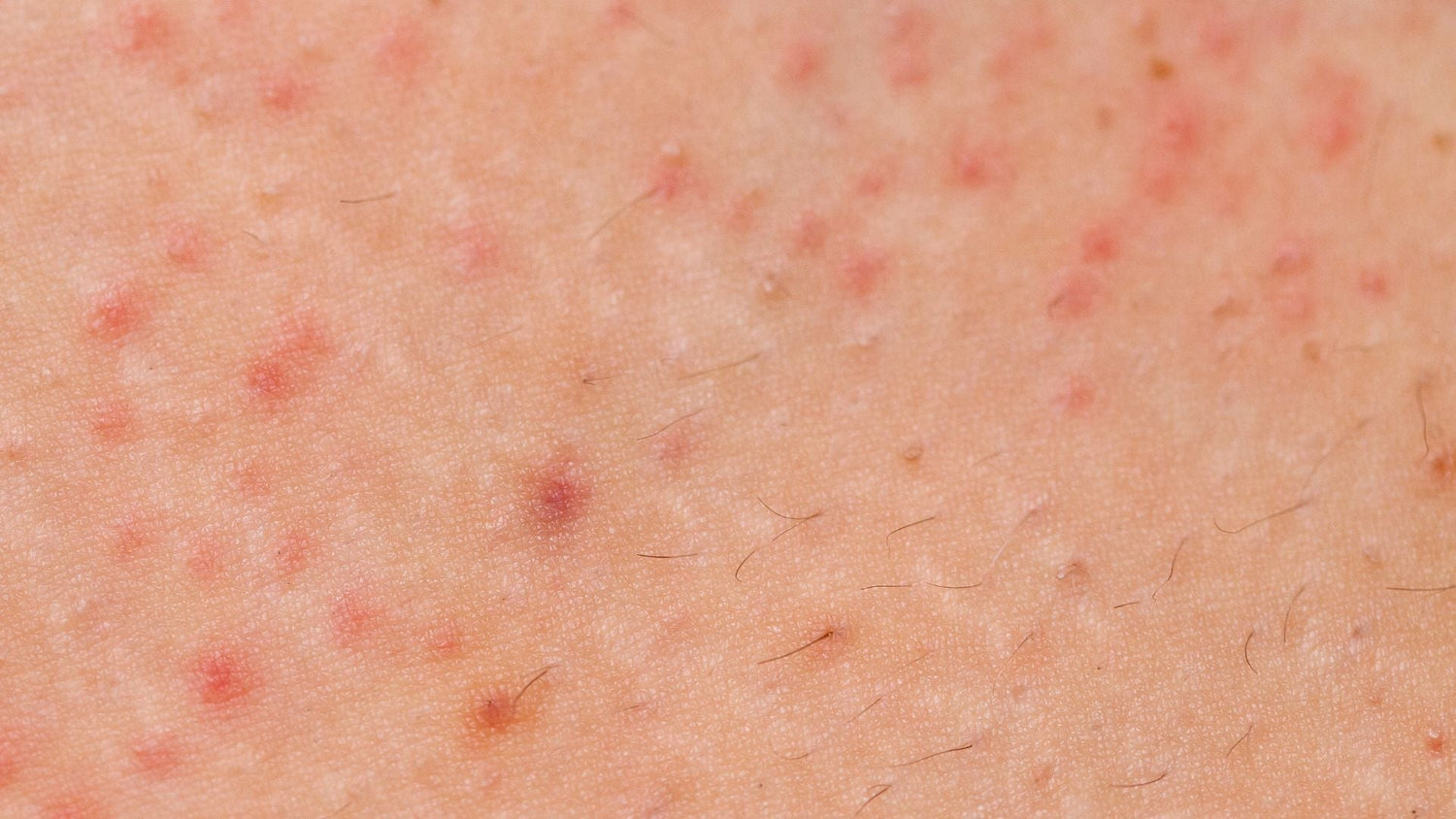Folliculitis Management: Antibiotic Stewardship Protocol