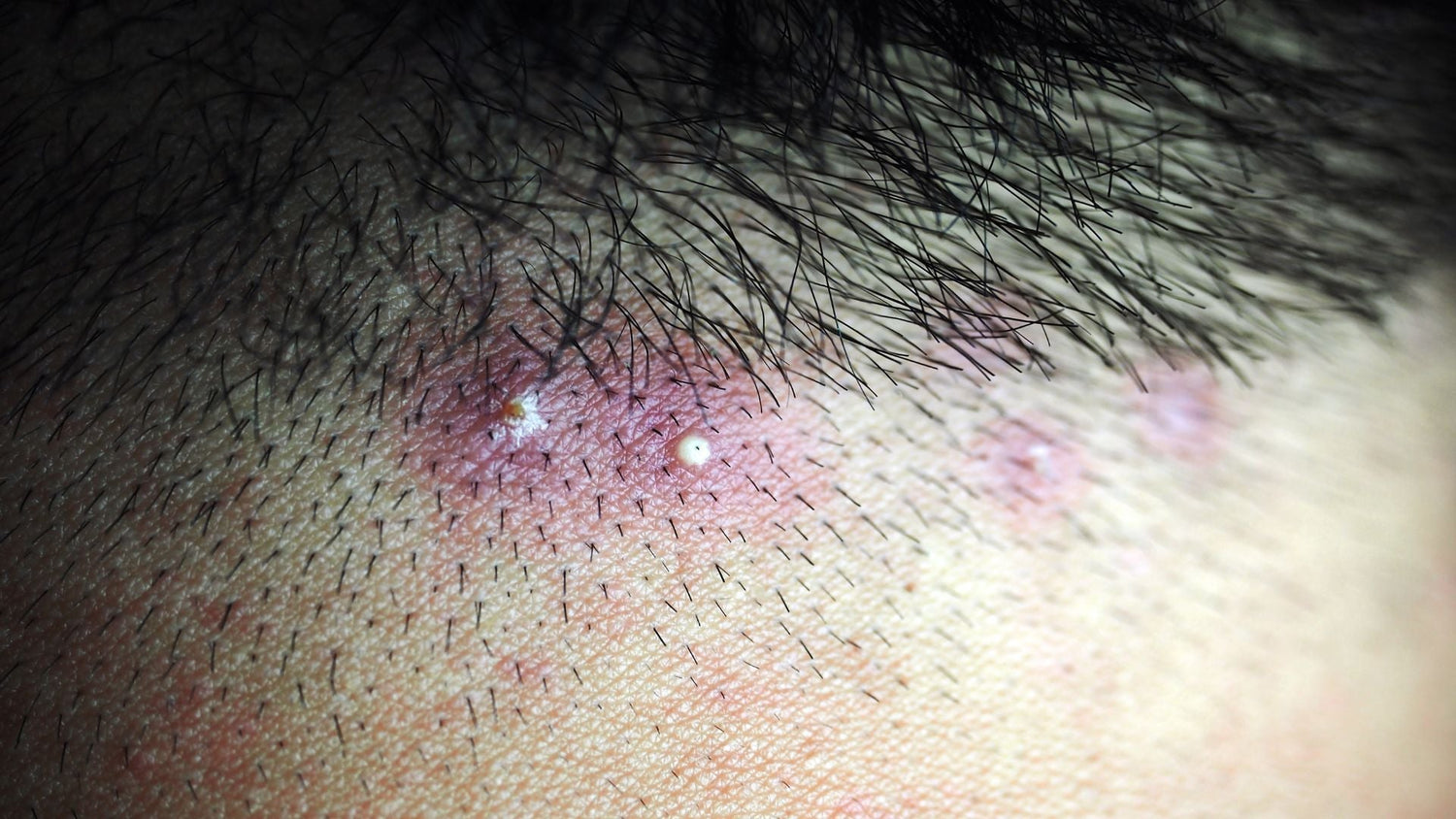 Household Decolonization Breaks the Cycle of Recurrent Folliculitis