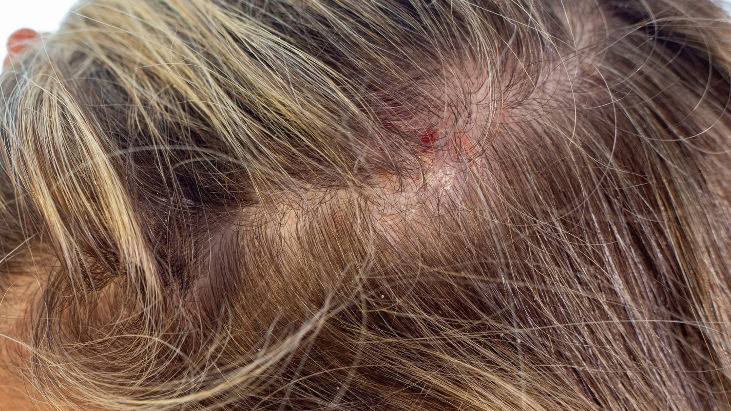 Sensitive Scalp Care: How Trigger Avoidance Restores Comfort and Balance