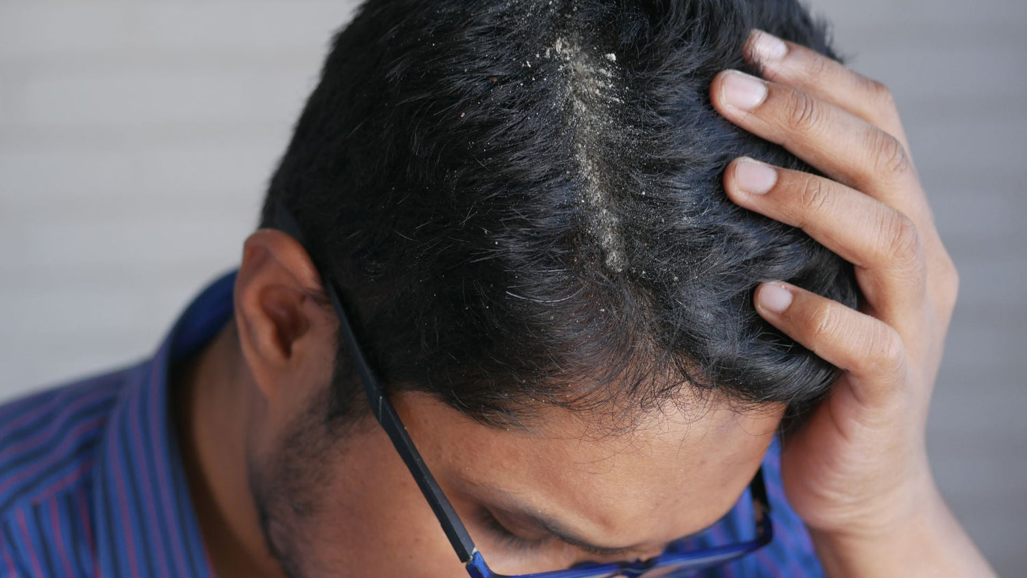 Structural and Follicular Scalp Disorders: Causes, Types, and Treatments