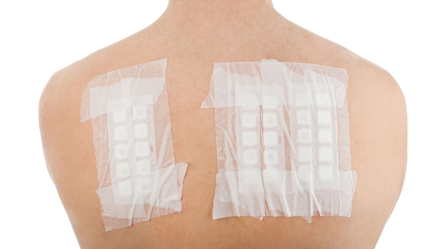 Patch Testing for Scalp Allergens: Implementation Checklist