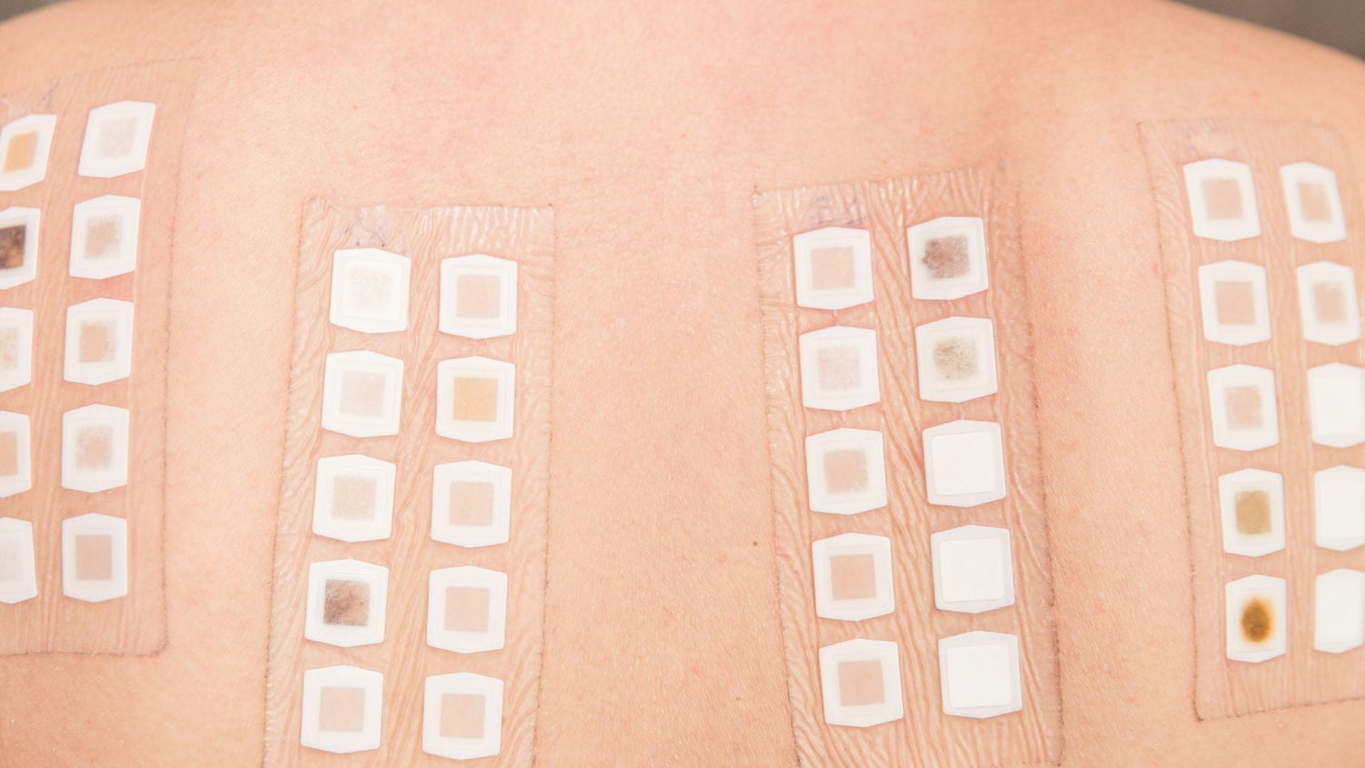 Patch Testing Explained: The Consumer’s Advanced Guide