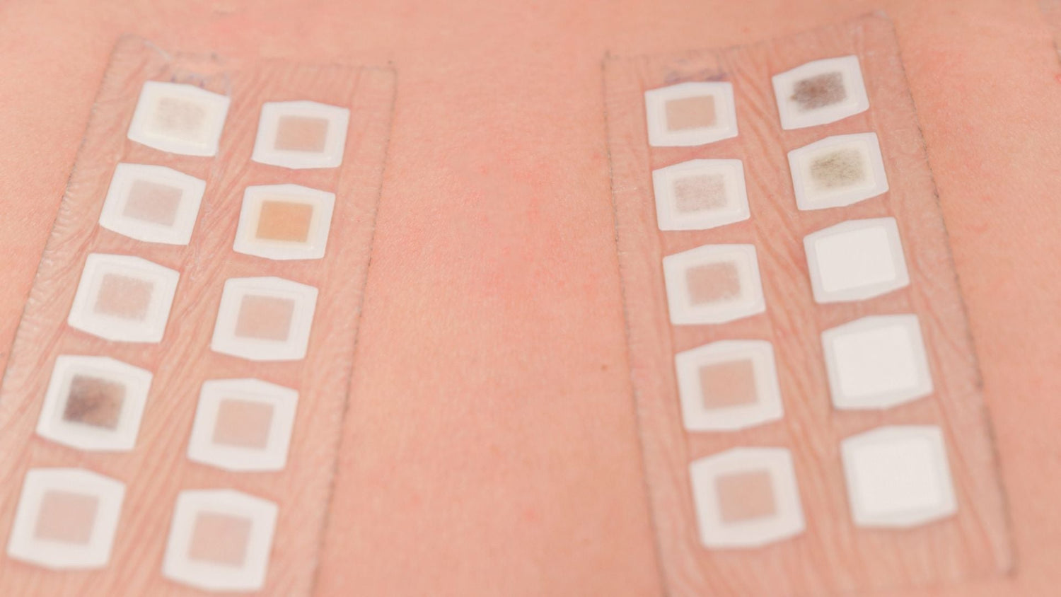 Patch Testing for Sensitive Scalp: Benchmarks for Guided Remission