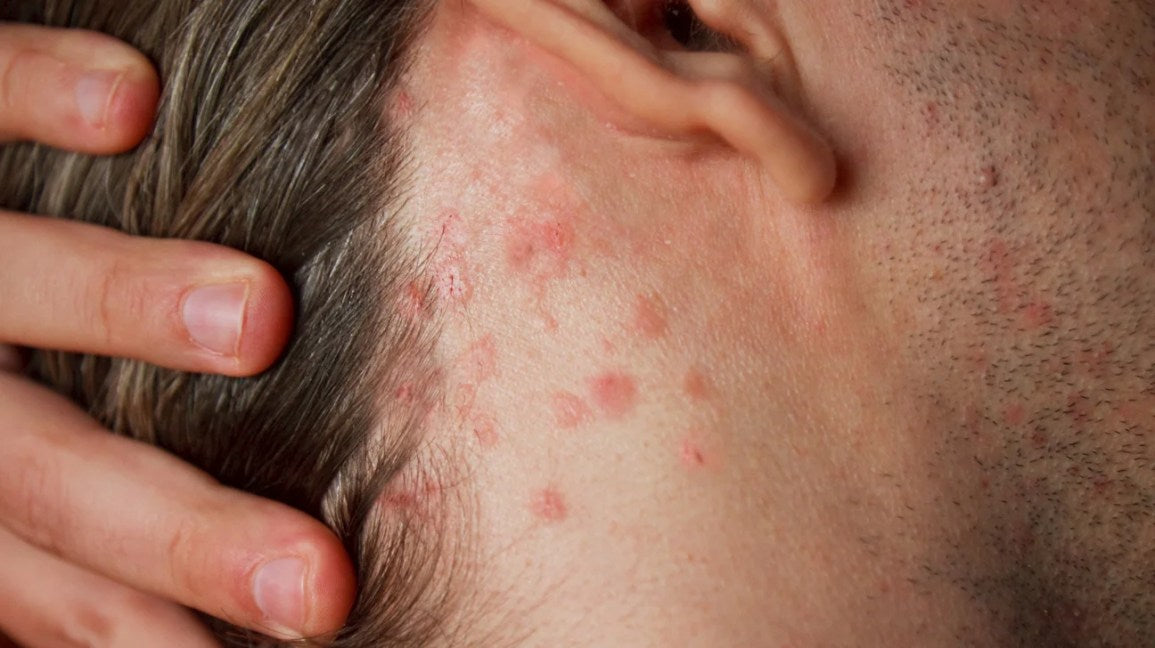 Scalp eczema on head and hair, seborrheic dermatitis, atopic dermatitis, contact dermatitis on head
