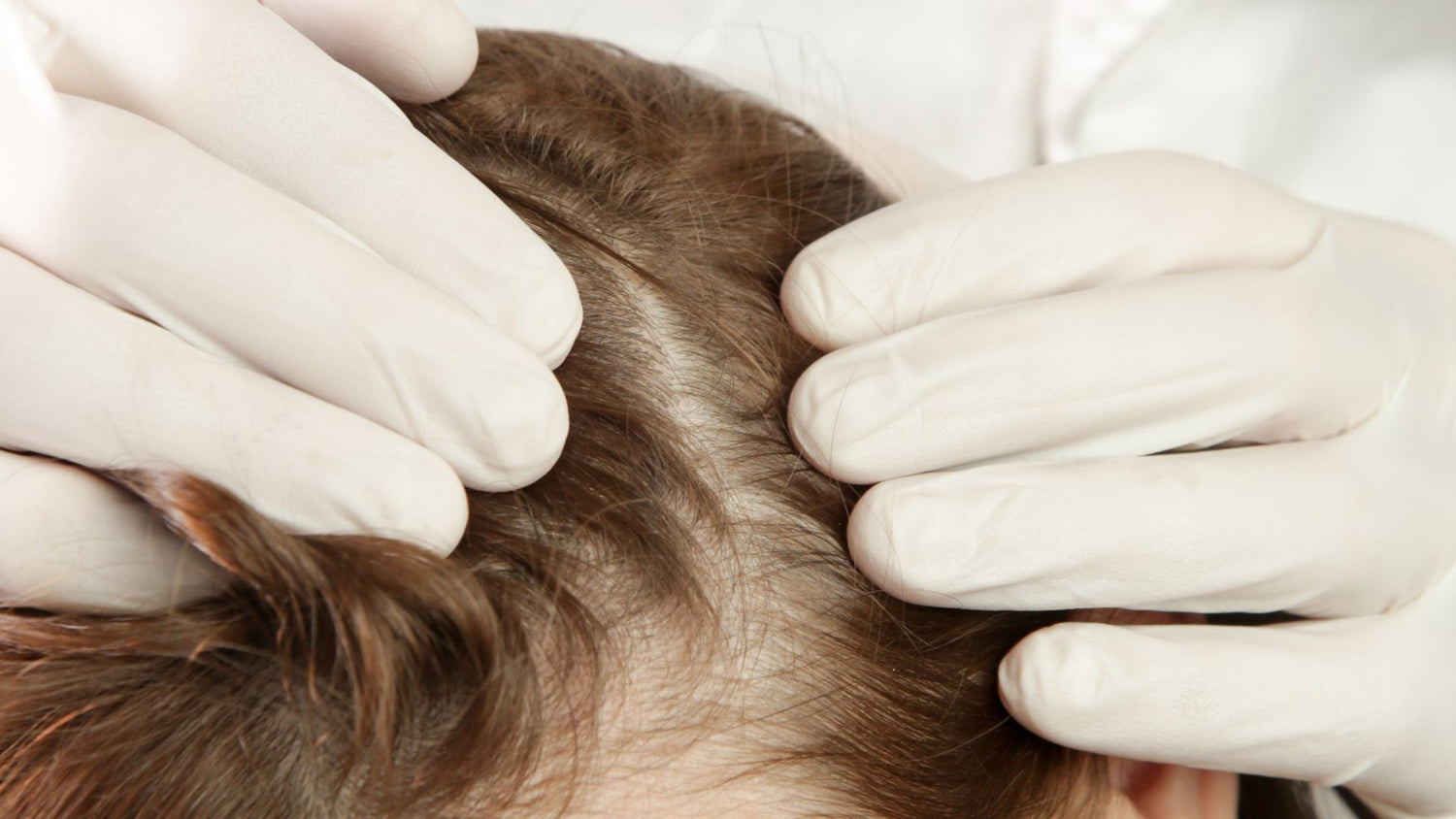 Scalp Infection Clearance: How Dermatologists Confirm True Healing