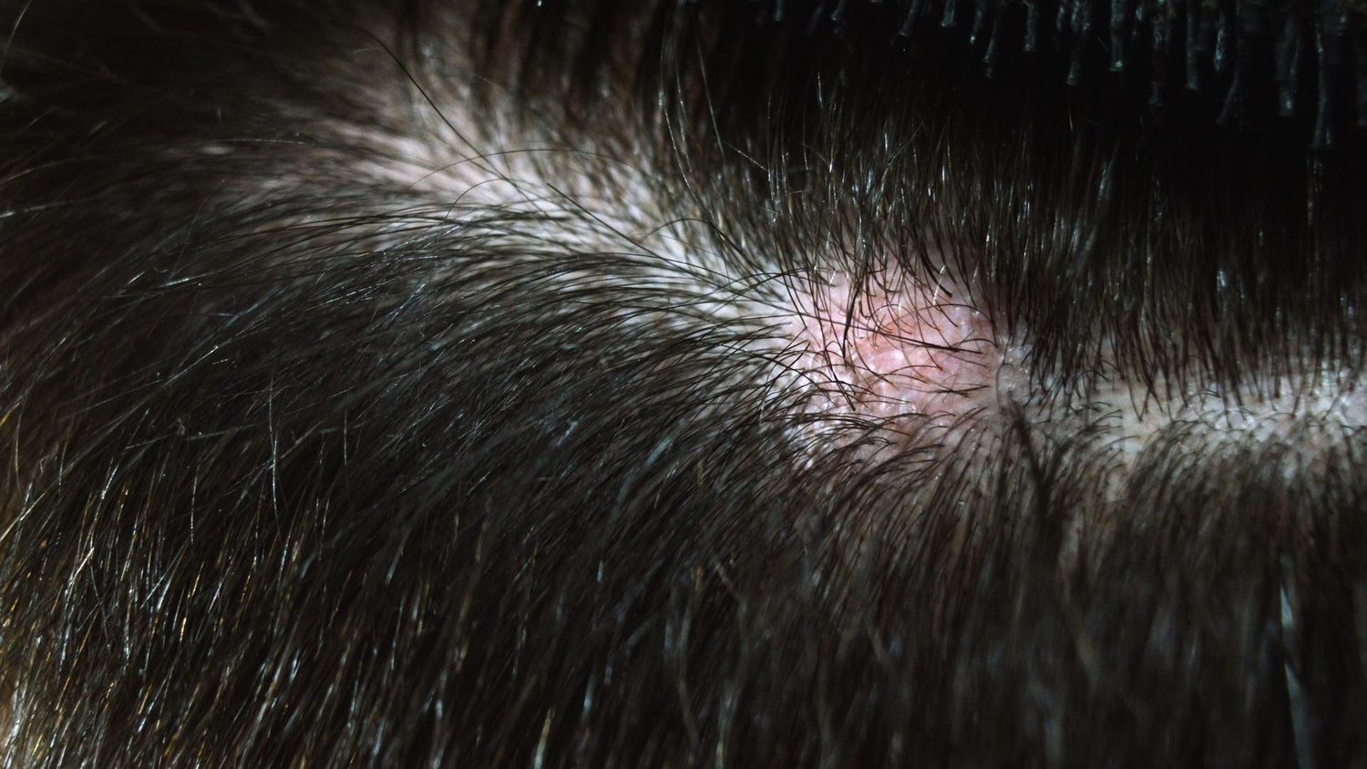 How Inflammatory Scalp Pathways Work