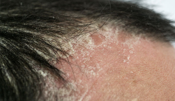 Does Psoriasis Cause Hair Loss and How Does It Affect the Scalp?