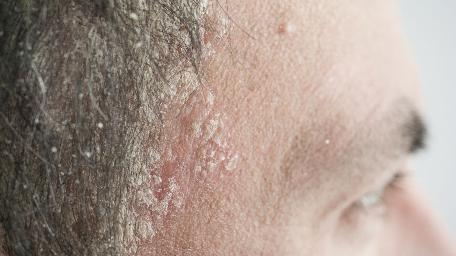 Scalp Psoriasis: How Cell Overgrowth Triggers Plaques and Itching