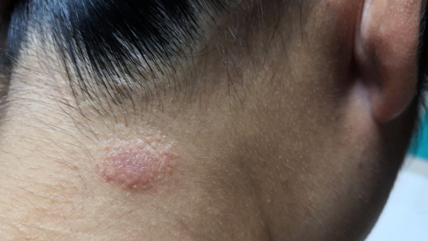 How Tinea Capitis Spreads and Persists