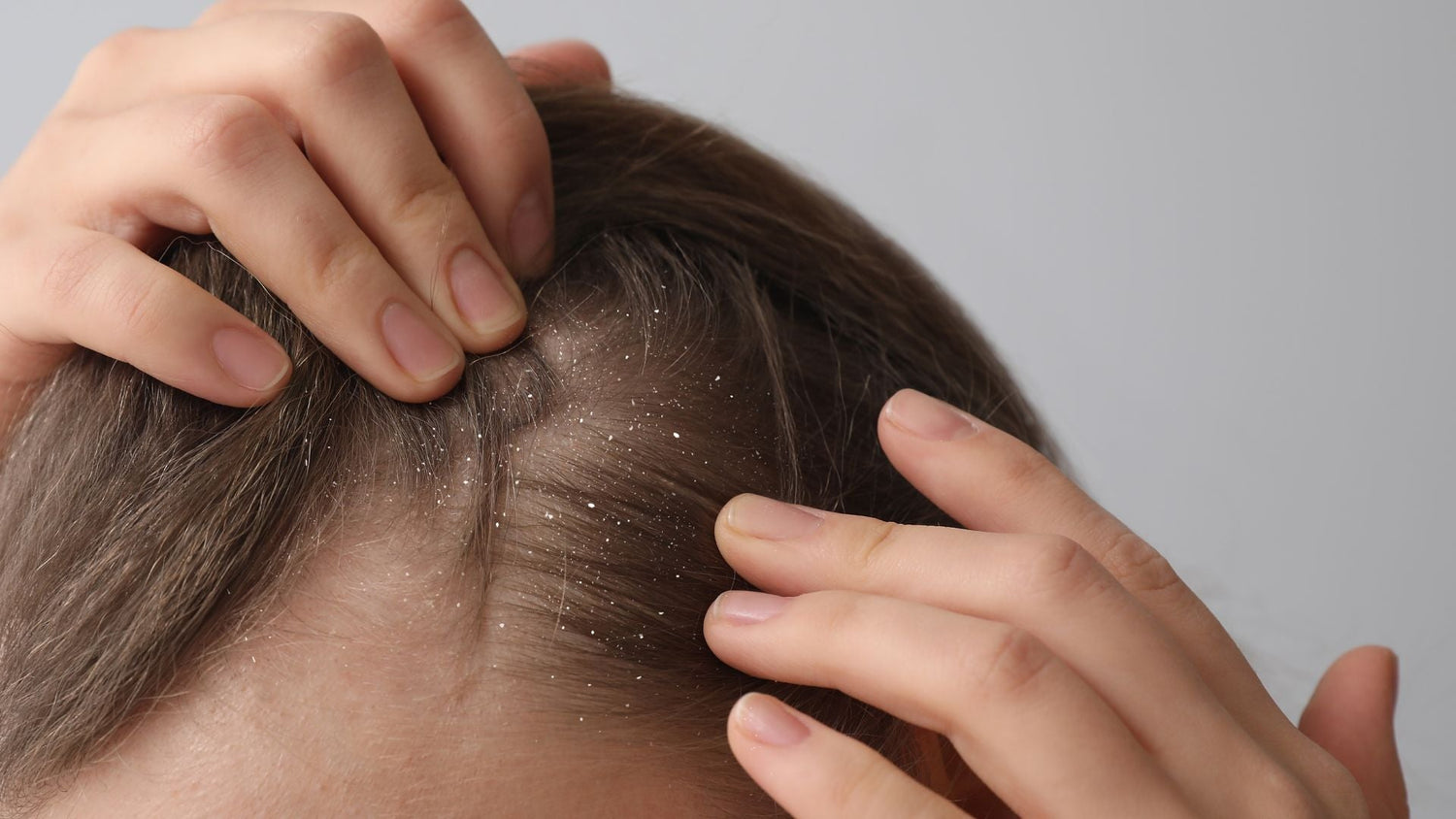 Roycederm Shampoo: The Gentle Step-Down Protocol for Lower-Irritation Seborrheic Dermatitis Control