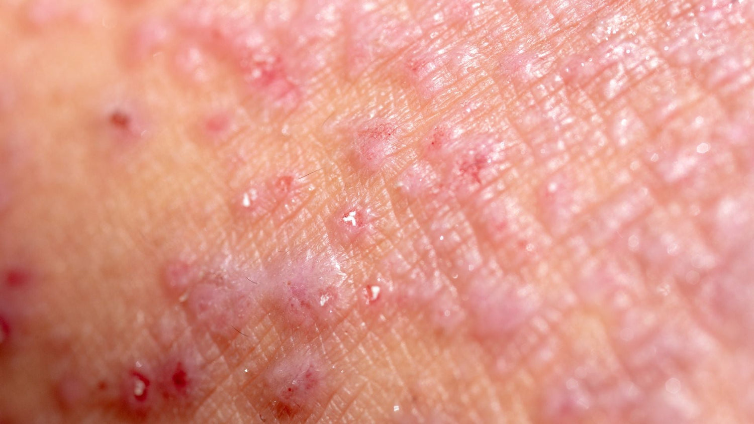 Scalp Contact Dermatitis: How Irritants and Allergens Trigger Inflammation