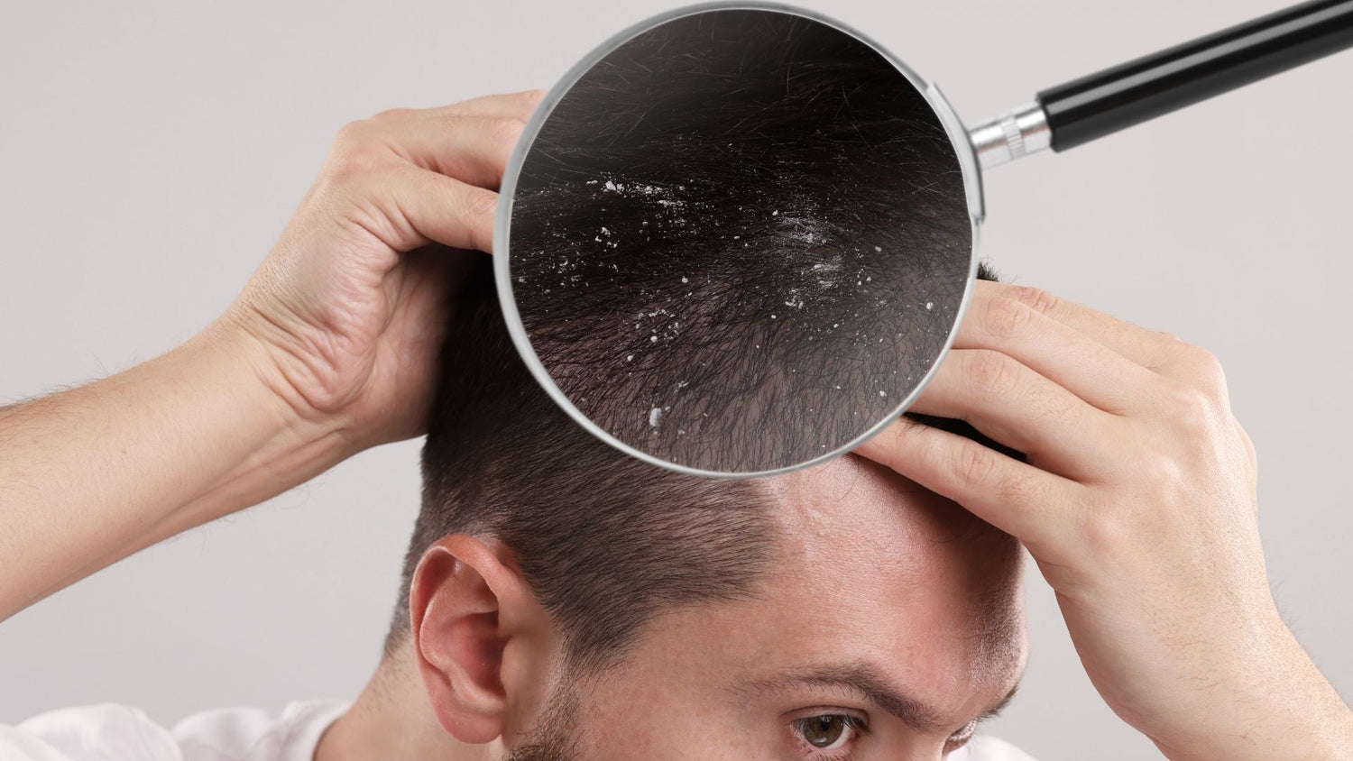 Measuring Scalp Flake Load and Redness with Patient and Clinician Scales