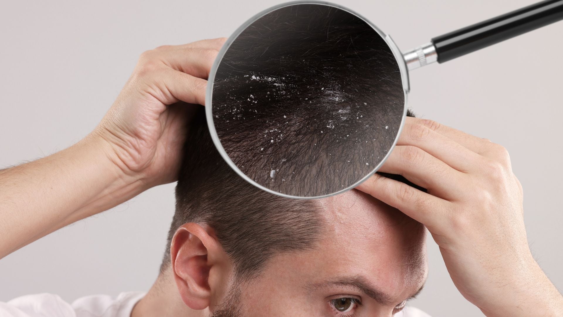 Measuring Scalp Flake Load and Redness with Patient and Clinician Scales