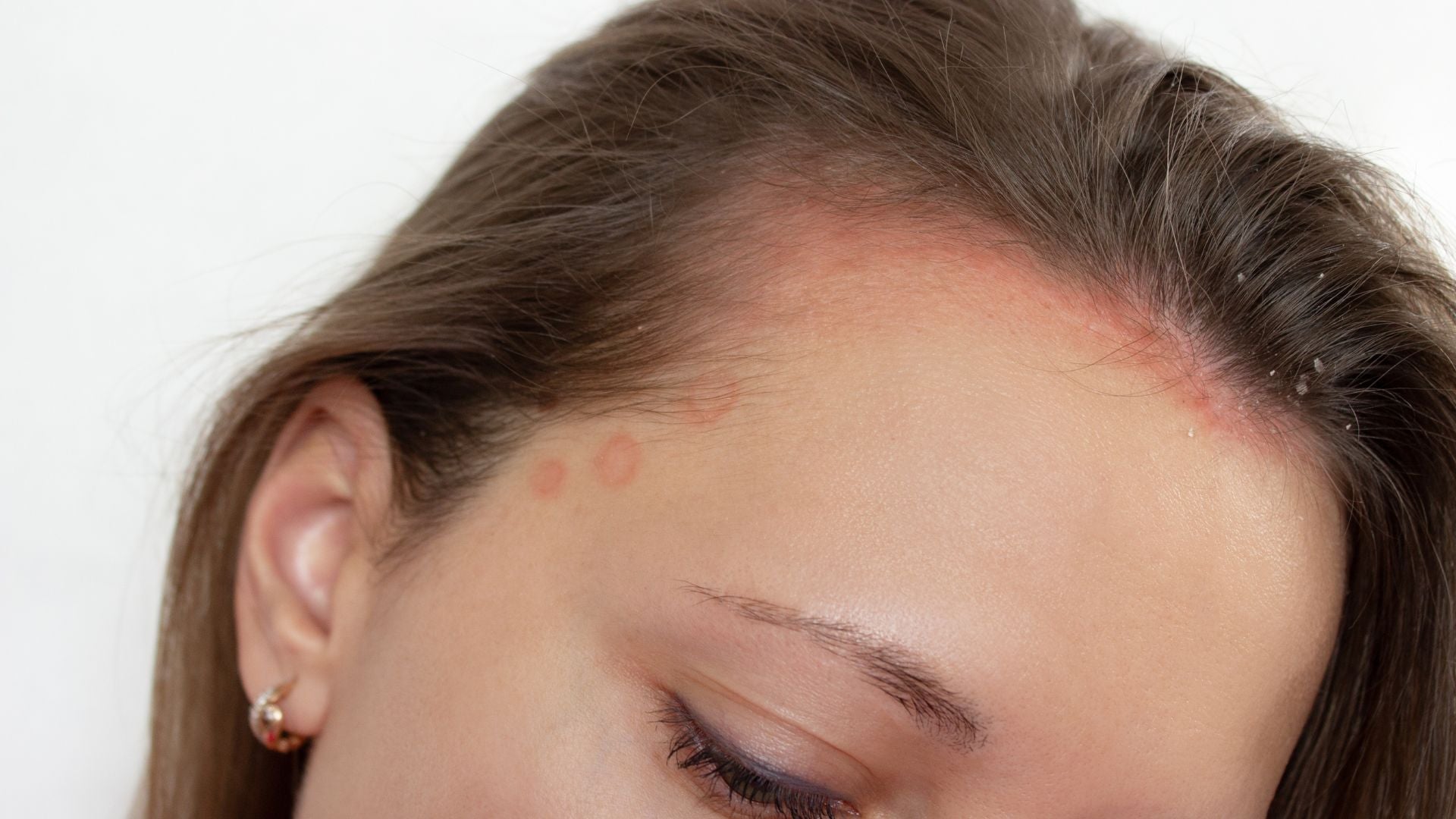 Scalp Flare-Up Explained: Signs, Causes, and When to Seek Help