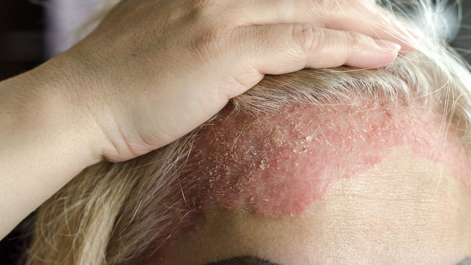 Scalp Psoriasis Treatment Workflow: Calming Flares and Restoring Scalp Health