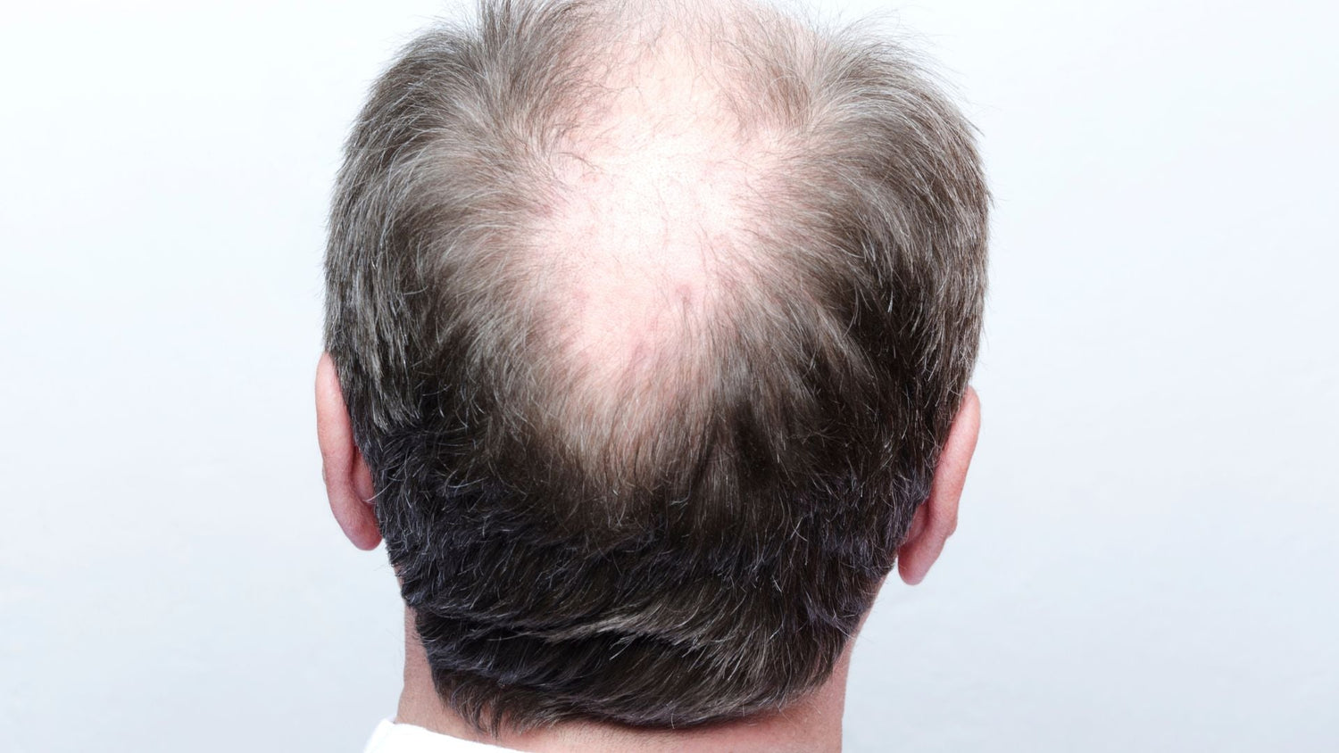 Cicatricial vs Androgenetic Alopecia: How Scarring Changes the Hair’s Future