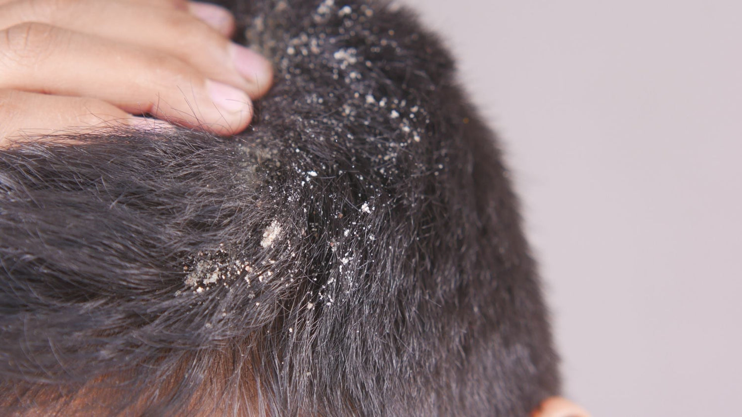 How Seborrheic Dermatitis Disrupts Desquamation
