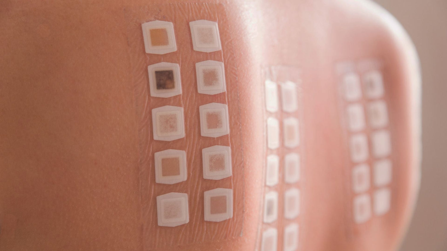 Patch Testing for Sensitive Scalps: Identifying Allergens Behind Irritation