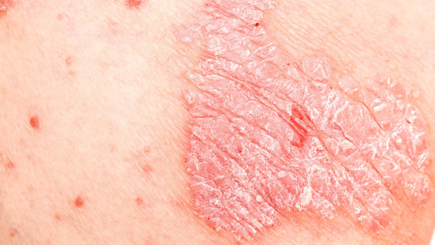 Scalp Psoriasis Remission Timelines: What to Expect from Treatment