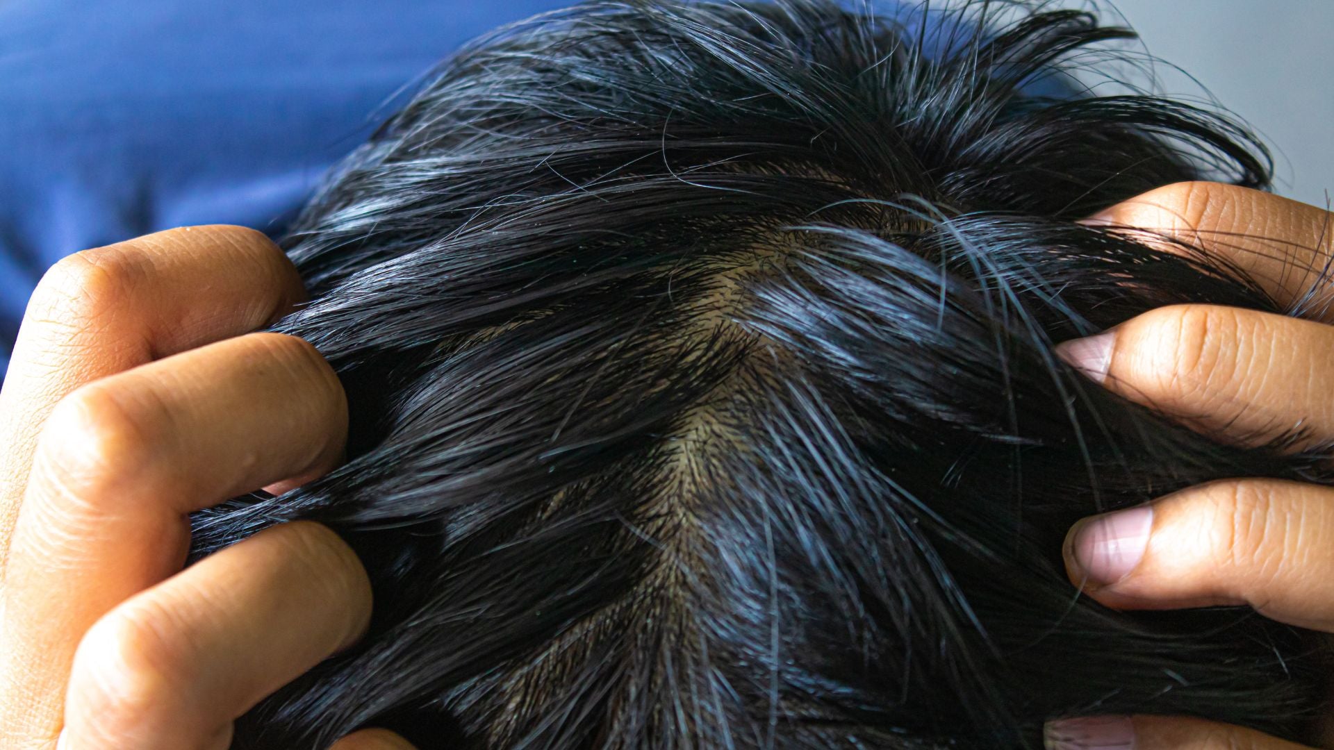 Dry Scalp, Buildup, or Dermatitis: identify signs, drivers, and treatments