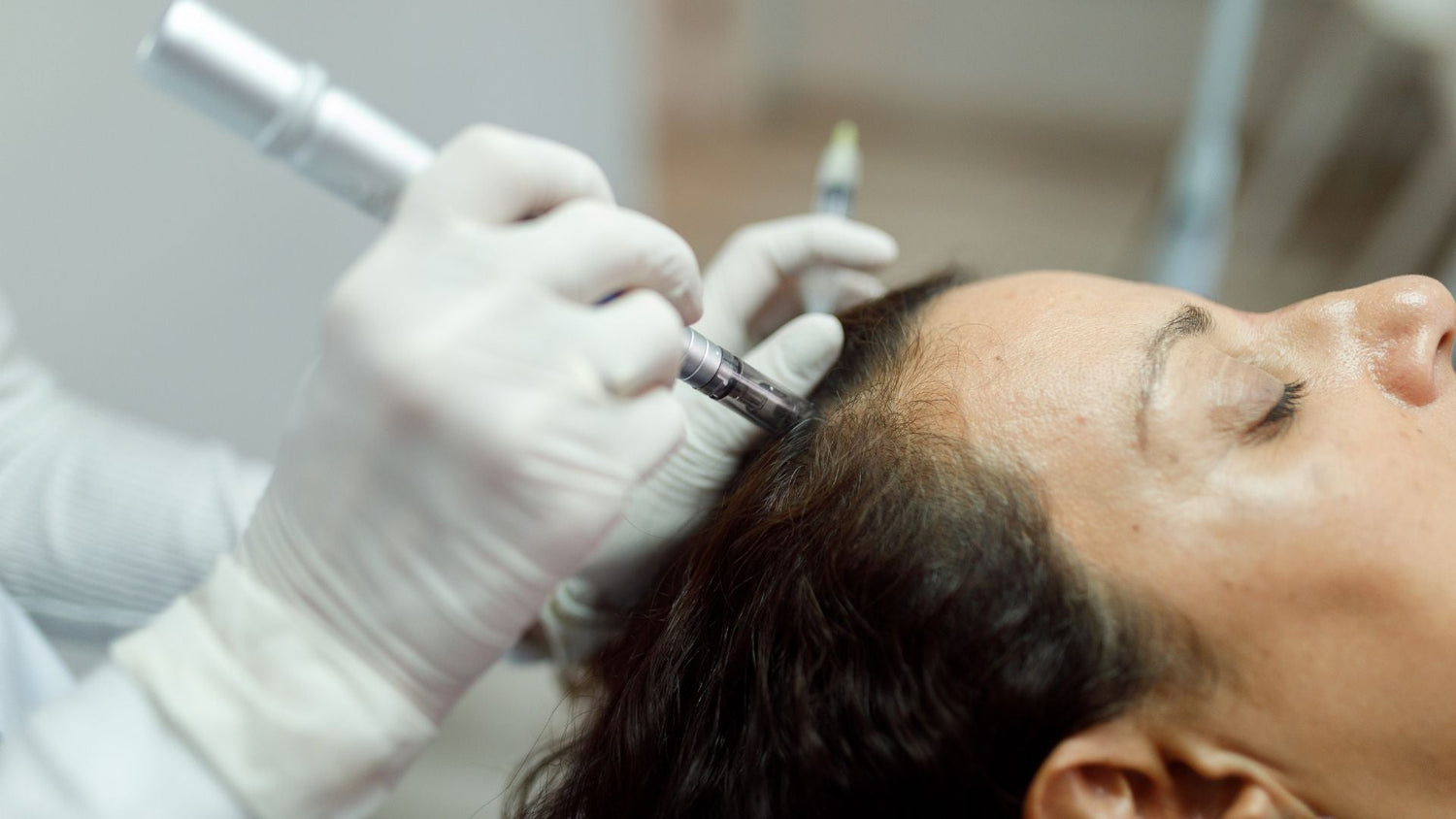 Microneedling for Hair Growth: Common Mistakes That Harm Scalp Health